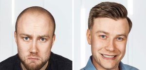 FUE hair transplant